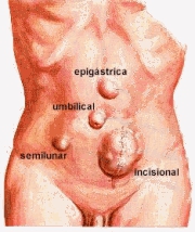 other_herniae.gif